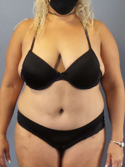 Abdominoplasty Before & After Patient #3437