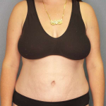 Abdominoplasty Before & After Patient #3409