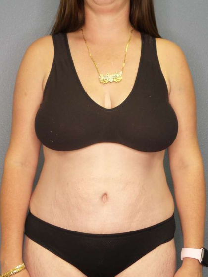 Abdominoplasty Before & After Patient #3409