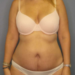 Abdominoplasty Before & After Patient #3350
