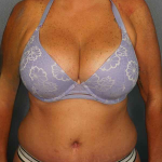 Abdominoplasty Before & After Patient #3272