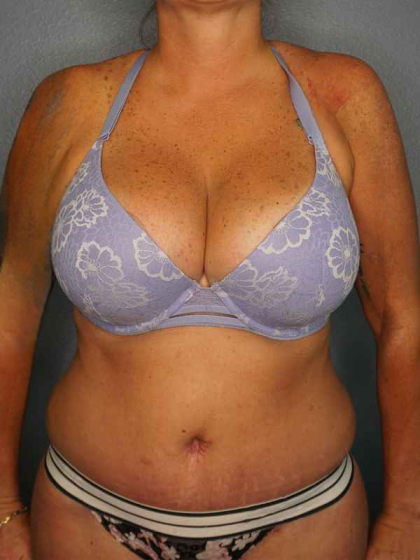 Abdominoplasty Before & After Patient #3272