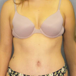 Abdominoplasty Before & After Patient #3236