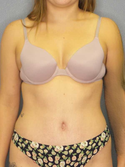 Abdominoplasty Before & After Patient #3236