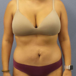 Abdominoplasty Before & After Patient #3225