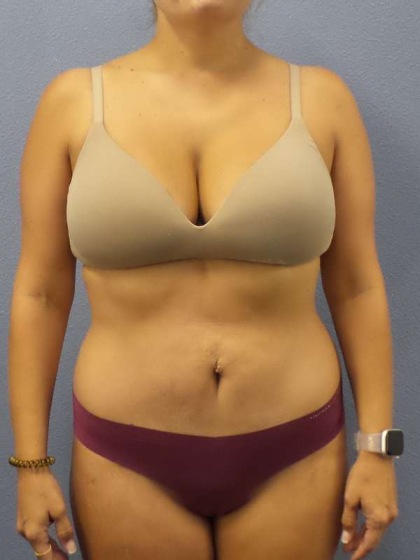 Abdominoplasty Before & After Patient #3225