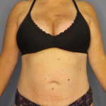 Liposuction Female Before & After Patient #11950