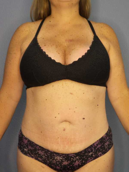 Liposuction Female Before & After Patient #11950