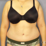 Abdominoplasty Before & After Patient #3188