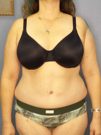 Abdominoplasty Before & After Patient #3188