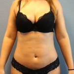 Liposuction Female Before & After Patient #11933