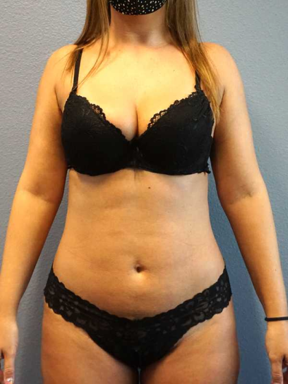 Liposuction Female Before & After Patient #11933