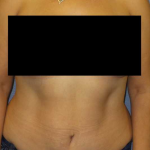 Abdominoplasty Before & After Patient #11131