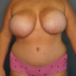 High BMI (Larger Patients) Surgery Before & After Patient #10431