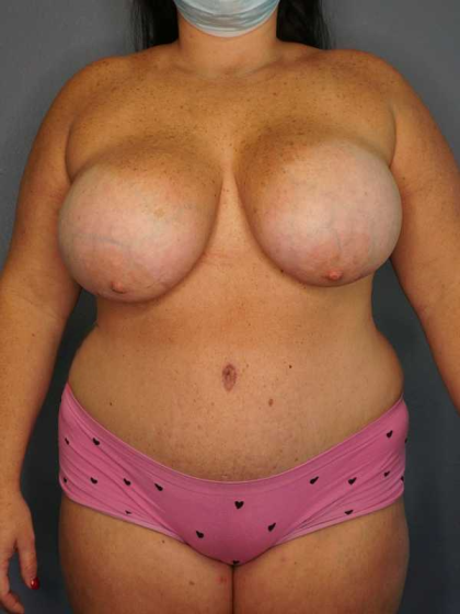 High BMI (Larger Patients) Surgery Before & After Patient #10431