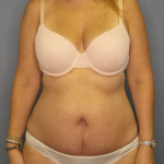 High BMI (Larger Patients) Surgery Before & After Patient #10329