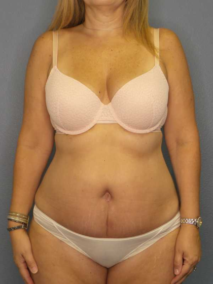 High BMI (Larger Patients) Surgery Before & After Patient #10329