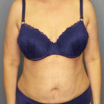 Liposuction Female Before & After Patient #7932