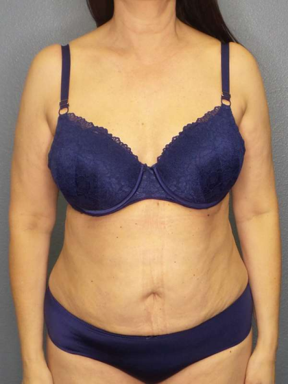 Liposuction Female Before & After Patient #7932
