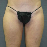 Liposuction Female Before & After Patient #7794