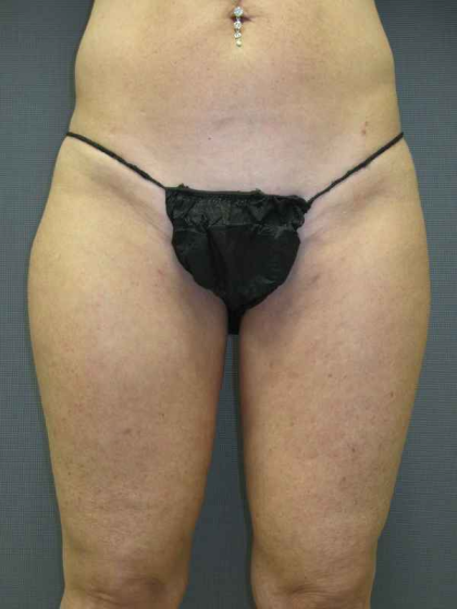 Liposuction Female Before & After Patient #7794