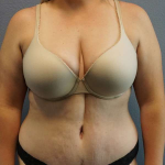 Abdominoplasty Before & After Patient #5197
