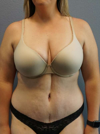 Abdominoplasty Before & After Patient #5197