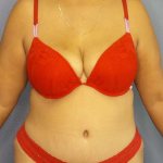 Abdominoplasty Before & After Patient #3638