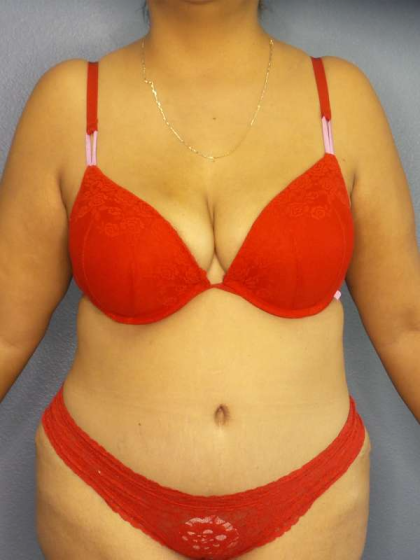 Abdominoplasty Before & After Patient #3638