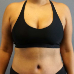 Abdominoplasty Before & After Patient #3583