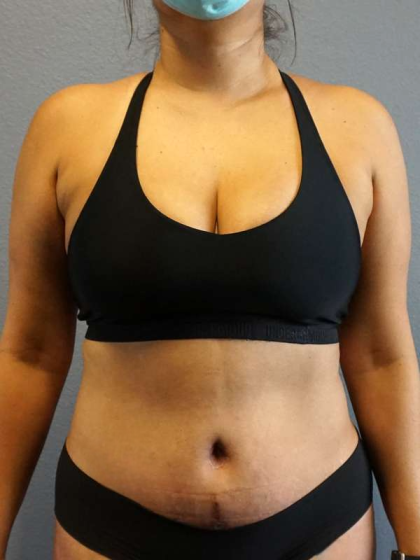 Abdominoplasty Before & After Patient #3583