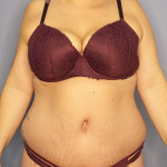 Abdominoplasty Before & After Patient #3572
