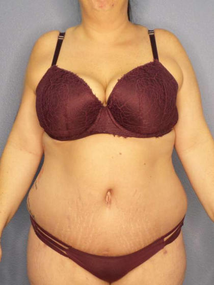 Abdominoplasty Before & After Patient #3572