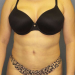 Liposuction Female Before & After Patient #7966