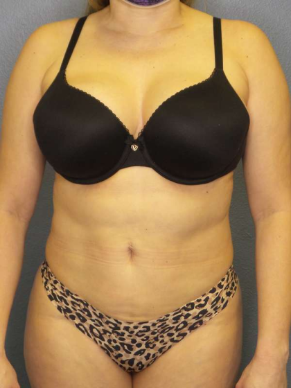 Liposuction Female Before & After Patient #7966