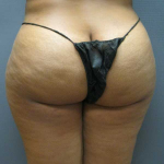 Brazilian Butt Lift Before & After Patient #4903