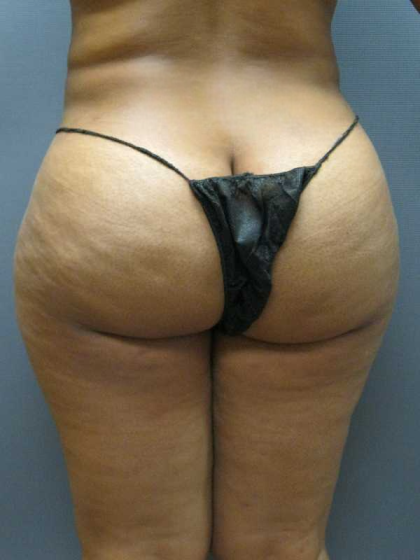 Brazilian Butt Lift Before & After Patient #4903