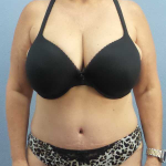 Abdominoplasty Before & After Patient #3786