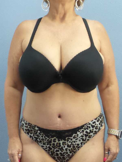 Abdominoplasty Before & After Patient #3786