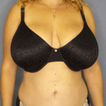 Liposuction Female Before & After Patient #8123