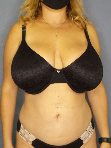 Liposuction Female Before & After Patient #8123