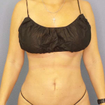 Liposuction Female Before & After Patient #8058