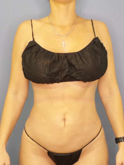 Liposuction Female Before & After Patient #8058