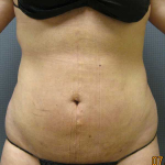 Liposuction Female Before & After Patient #7776