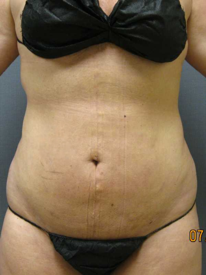 Liposuction Female Before & After Patient #7776