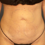 Liposuction Female Before & After Patient #7692