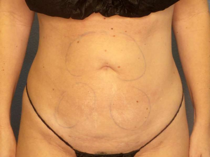 Liposuction Female Before & After Patient #7692