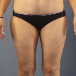 Liposuction Female Before & After Patient #7709