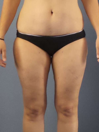 Liposuction Female Before & After Patient #7709