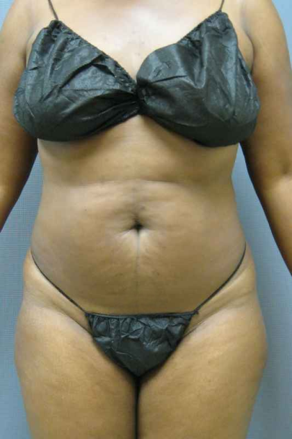 Liposuction Female Before & After Patient #7668